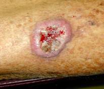 Carcinoma espinocelular